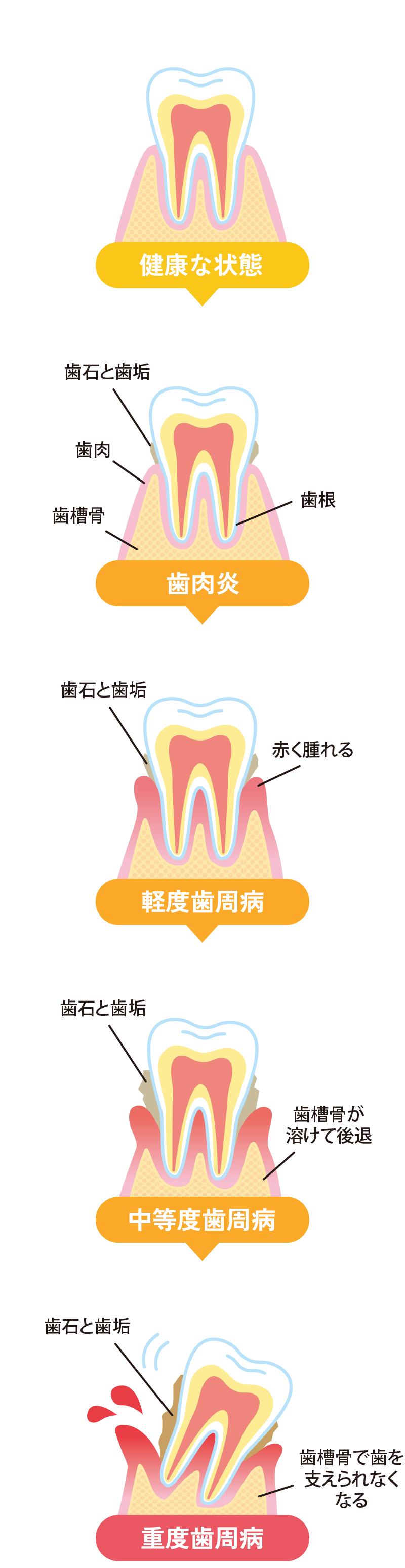 歯周病の進行